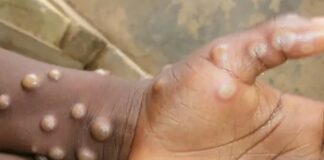 Confirman 7 casos de viruela del mono en España y Portugal; hay 40 sospechosos