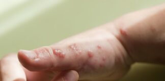 Dan a conocer en Chihuahua síntomas de la Viruela del Mono