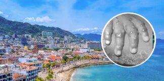 Texano llega con viruela de mono a Jalisco y se escapa del hospital