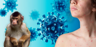 Viruela del mono es emergencia global; máxima alerta de la OMS