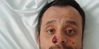 Estados Unidos declara emergencia de salud pública por brote de viruela del mono