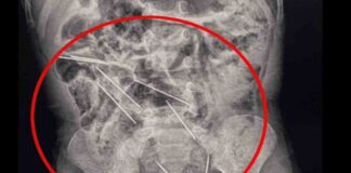 Bebé de 2 años se traga 8 agujas y logra sobrevivir