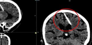 Abuelita descubre que llevó una aguja en el cerebro por 80 años