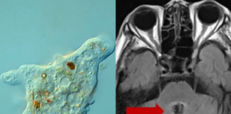Médicos diagnostican a abuelita con cáncer cerebral; en realidad una ameba la devoraba