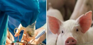 Dan de alta al primer paciente trasplantado con un riñón de cerdo