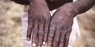 Detectan la nueva variante de viruela del mono por primera vez en Tailandia