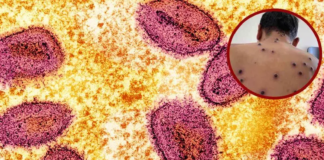 Viruela del mono: Estos estados han reportado casos en México