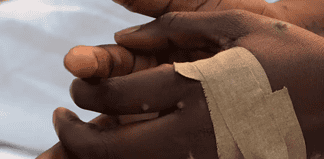 Viruela del mono: Reportan seis casos más en una semana en México