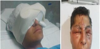 Quedó ciego estudiante del CECyTECH tras explotarle experimento en la cara